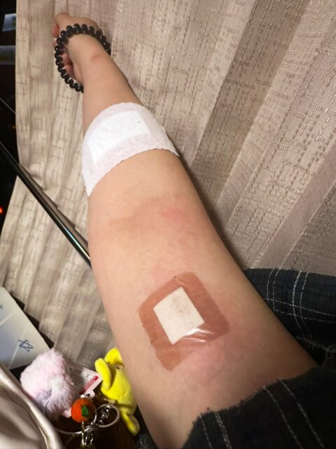 Burn injuries from SEVENTEEN concert